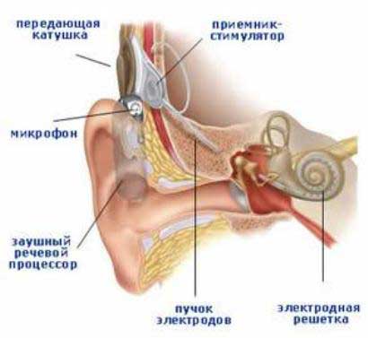 Кохлеарные имплантаты — сенсация в восстановлении слуха даже при полной глухоте