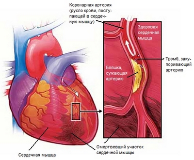 Инфаркт: 10 факторов риска, которые должен знать каждый
