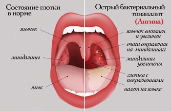 Ангина: симптомы и лечение ангины