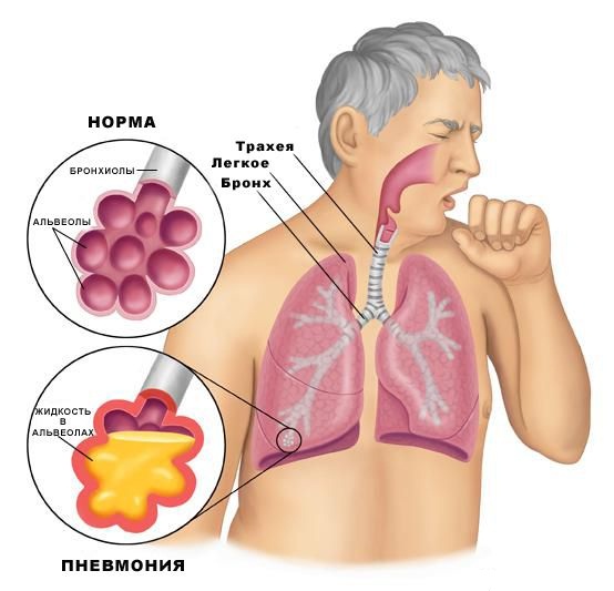Симптомы пневмонии у взрослых, народное лечение пневмонии 