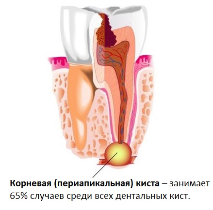 Зубная киста – симптомы, виды, лечение