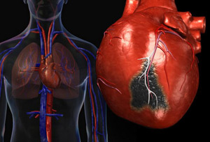 Инфаркт: симптомы и лечение