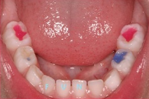 Виды зубных пломб и их сравнение