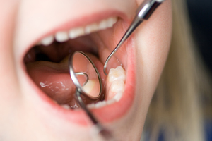 Серебрение зубов у детей – отзывы
