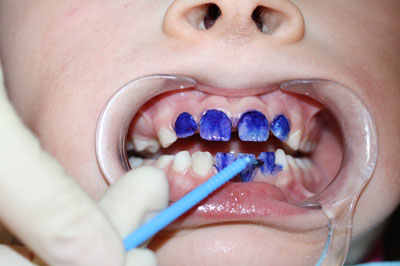 Серебрение зубов у детей – отзывы