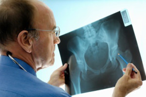 Причины, симптомы и лечение остеопороза, профилактика