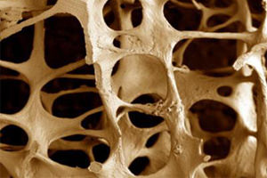 Причины, симптомы и лечение остеопороза, профилактика