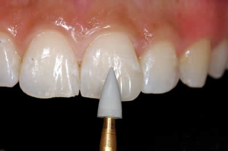 Профессиональная чистка зубов: показания, противопоказания, методики