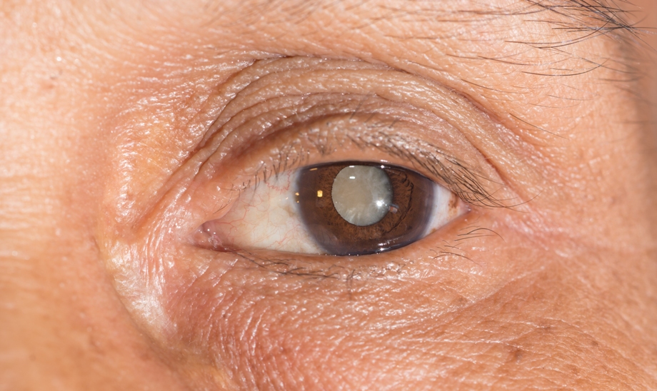 8 заблуждений о катаракте
