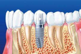 Рекомендации для пациента при имплантации зубов