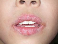 Болят уголки губ, трещины, заеды в уголках рта