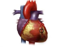Как заставить сердечников принимать лекарства