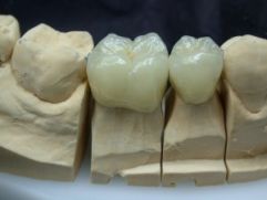 Металлокерамика и протезирование зубов