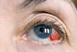 Причины кровоизлияния в глаз