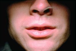 Причина импотенции - состояние рта