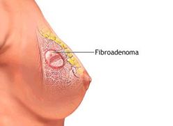 Лечение фиброзной мастопатии