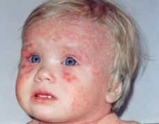 дерматит на лице у ребенка лечение