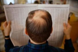 Выпадение волос у мужчин при андрогенной алопеции (АА)