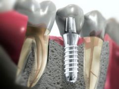 Имплантация  зубов в ЦИМ 