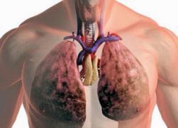 Диспансерное наблюдение пациентов с болезнями органов дыхания
