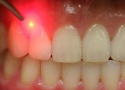 Лазерная стоматология: лечение без боли