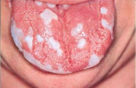 Кандидоз (молочница) слизистой оболочки рта