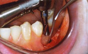 Имеются ли осложнения у зубной имплантации?