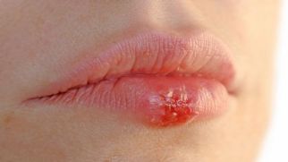 Как лечить герпес на губах и какое средство от герпеса выбрать?