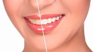 Отбеливание зубов: что необходимо знать каждому 