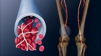 Венозный тромбоз сосудов ног: от первых признаков и профилактики до борьбы с болезнью