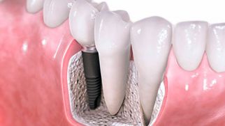 Одномоментная имплантация зубов — быстрая замена зубов при здоровой челюсти