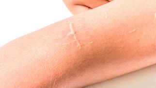Новый эффективный метод удаления шрамов и рубцов — букки-терапия